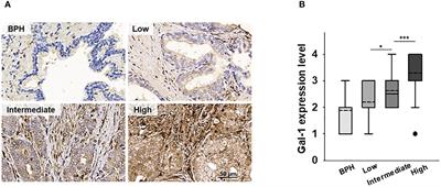 Improving cancer immunotherapy in prostate cancer by modulating T cell function through targeting the galectin-1